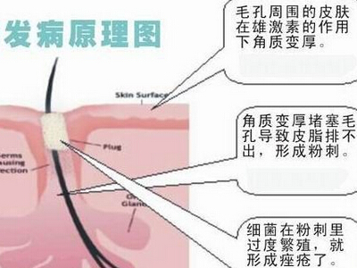 为什么会长痘痘(图1) 南阳皮肤病医院