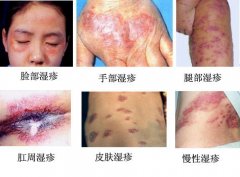 湿疹有哪些症状
