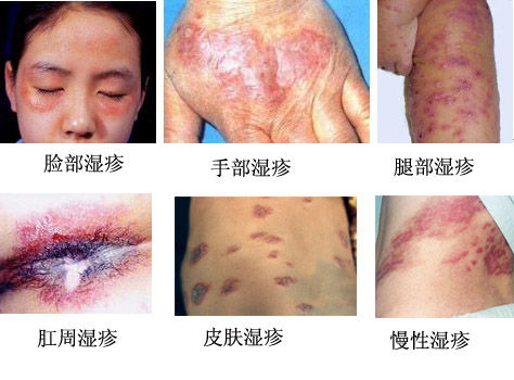 湿疹有哪些症状(图1) 南阳皮肤病医院