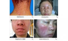 皮炎有哪些症状