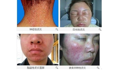 皮炎有哪些症状(图1) 南阳皮肤病医院