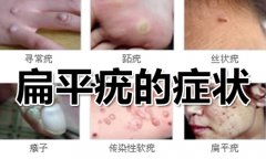 扁平疣有什么症状