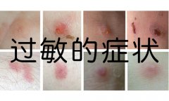 皮肤过敏什么样子
