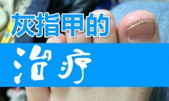 灰指甲用什么药好