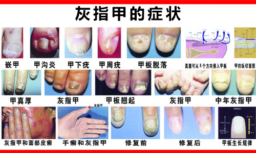 灰指甲常见症状有哪些(图1) 南阳皮肤病医院