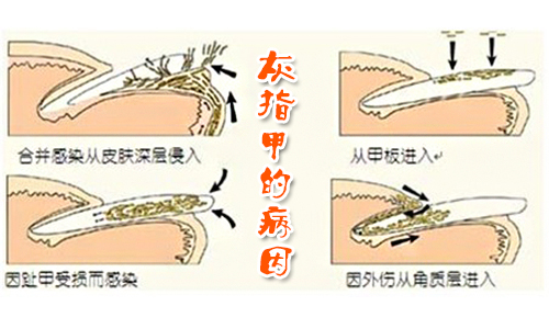 得灰指甲的原因(图1) 南阳皮肤病医院