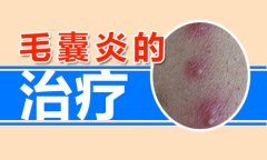 毛囊炎怎么治疗