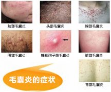 毛囊炎的症状是什么