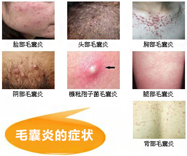 毛囊炎的症状是什么(图1) 南阳皮肤病医院