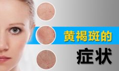 黄褐斑有哪些症状