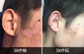 深层解析白癜风病因 合理诊疗是关键(图2)