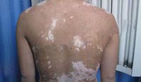 深层解析白癜风病因 合理诊疗是关键(图1)