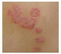 了解牛皮癣症状 对症治疗疾病(图1)
