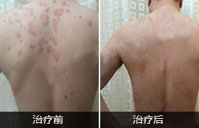 牛皮癣危害大 患者不可小窥(图3)