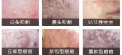 不同类型青春痘的症状及治疗费用