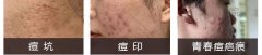 乱挤痘痘或不当治疗会留下毁容性疤痕