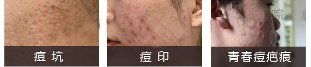 乱挤痘痘或不当治疗会留下毁容性疤痕(图1)