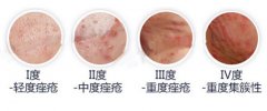 脸上红肿有黑头是怎么回事？