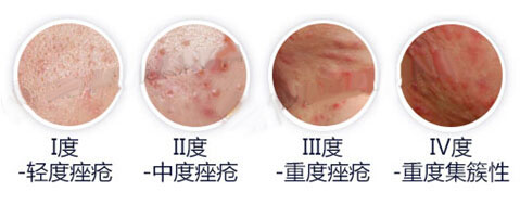 脸上红肿有黑头是怎么回事？(图1)