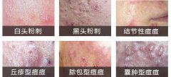 目前 常用且有效的祛痘方法