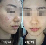 终于战胜了与痘痘的拉锯战