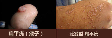 扁平疣（瘊子）能不能根治(图1)