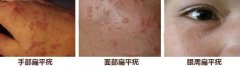 扁平疣是什么样子 该怎么治