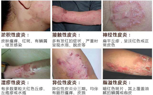 6种常见皮炎症状(图1)