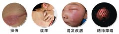 警惕 皮炎可能诱发其他疾病