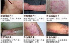 皮炎类型不同 治疗方法不同