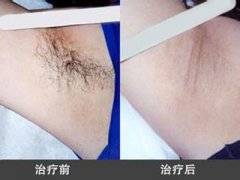 摆脱腋臭，拥抱幸福